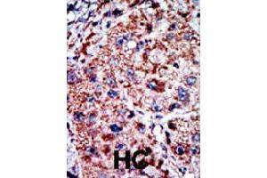 Formalin-fixed and paraffin-embedded human hepatocellular carcinoma tissue reacted with PFKL polyclonal antibody  , which was peroxidase-conjugated to the secondary antibody, followed by AEC staining. (PFKL 抗体  (C-Term))