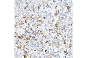 Immunohistochemistry of paraffin-embedded human lung cancer using ACTR2 antibody.
