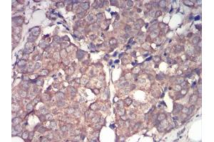 Immunohistochemical analysis of paraffin-embedded breast cancer tissues using IRAK3 mouse mAb with DAB staining. (IRAK3 抗体  (AA 454-596))
