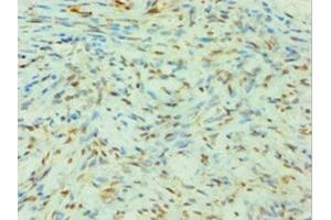 Immunohistochemistry of paraffin-embedded human breast cancer using ABIN7144142 at dilution of 1:100 (SLC4A2 抗体  (AA 95-245))