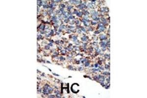 Formalin-fixed and paraffin-embedded human cancer tissue reacted with the primary antibody, which was peroxidase-conjugated to the secondary antibody, followed by AEC staining. (PI3KC2G 抗体  (N-Term))