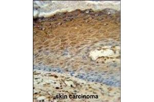 AK7 Antibody (C-term) (ABIN391103 and ABIN2841238) immunohistochemistry analysis in formalin fixed and paraffin embedded human skin carcinoma followed by peroxidase conjugation of the secondary antibody and DAB staining. (Adenylate Kinase 7 抗体  (C-Term))