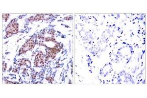 Immunohistochemical analysis of paraffin-embedded human breast carcinoma tissue using Elk-1 (phospho-Ser383) antibody (E011004). (ELK1 抗体  (pSer383))