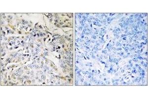 Immunohistochemistry analysis of paraffin-embedded human breast carcinoma tissue, using RBM34 Antibody. (RBM34 抗体  (AA 345-394))