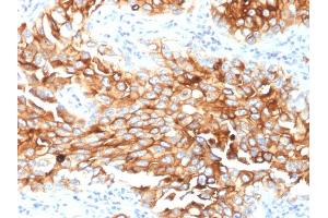 Formalin-fixed, paraffin-embedded human Lung Mesothelioma stained with Mesothelin Mouse Monoclonal Antibody (MSLN/2131).