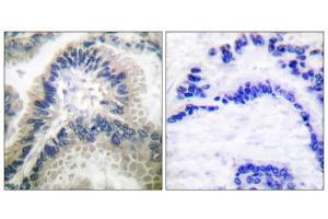 Immunohistochemical analysis of paraffin-embedded human lung carcinoma tissue using Guanylate Cyclase beta antibody (ABIN5976418). (GUCYB 抗体  (N-Term))