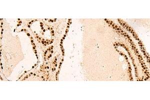 Immunohistochemistry of paraffin-embedded Human thyroid cancer tissue using SNRPB2 Polyclonal Antibody at dilution of 1:75(x200) (SNRPB2 抗体)