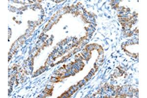 The image on the left is immunohistochemistry of paraffin-embedded Human esophagus cancer tissue using ABIN7192908(TRIM47 Antibody) at dilution 1/20, on the right is treated with synthetic peptide. (TRIM47 抗体)