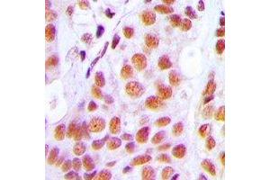 Immunohistochemical analysis of PRPF3 staining in human breast cancer formalin fixed paraffin embedded tissue section. (PRPF3 抗体)