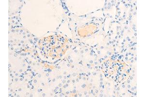 Immunohistochemistry (IHC) image for anti-Receptor tyrosine-protein kinase erbB-2 (ErbB2/Her2) (pTyr877) antibody (ABIN6256054)