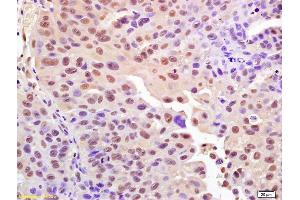 Formalin-fixed and paraffin embedded human bladder carcinoma labeled with Anti-Phospho-Histone H2A. (H2AFX 抗体  (pSer140))