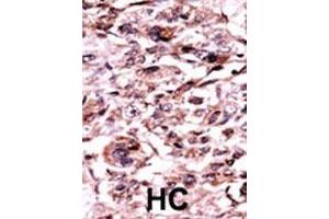 Formalin-fixed and paraffin-embedded human cancer tissue reacted with the primary antibody, which was peroxidase-conjugated to the secondary antibody, followed by AEC staining. (ABL1 抗体  (pTyr245))