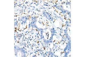 Immunohistochemistry of paraffin-embedded Human colon carcinoma using CD74 antibody (ABIN6128421, ABIN6138228, ABIN6138230 and ABIN6221316) at dilution of 1:25 (40x lens). (CD74 抗体  (AA 73-232))