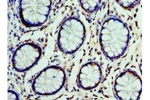 Immunohistochemistry of paraffin-embedded human colon cancer using ABIN7149003 at dilution of 1:100 (CST7 抗体  (AA 20-145))