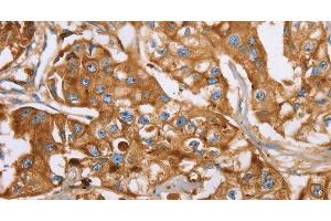 Immunohistochemistry of paraffin-embedded Human breast cancer using LTF Polyclonal Antibody at dilution of 1:40 (Lactoferrin 抗体)