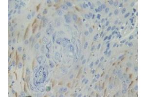 DAB staining on IHC-P; Samples: Human Skin cancer Tissue (BCAM 抗体  (AA 32-257))