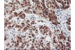 Immunohistochemical staining of paraffin-embedded Carcinoma of Human lung tissue using anti-HSPBP1 mouse monoclonal antibody. (HSPBP1 抗体)