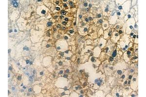 ABIN6263852 and ABIN6272721 at 1/100 staining human hepatocellular carcinoma by IHC-P.