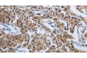 Immunohistochemistry of paraffin-embedded Human lung cancer tissue using PDCD7 Polyclonal Antibody at dilution 1:60 (PDCD7 抗体)