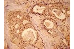 Immunohistochemistry analysis of human breast cancer tissue with MEK1 pAb. (MEK1 抗体  (N-Term))