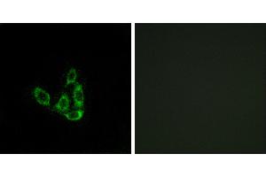 Peptide - +Immunohistochemistry analysis of paraffin-embedded human liver carcinoma tissue using GCNT3 antibody. (GCNT3 抗体)