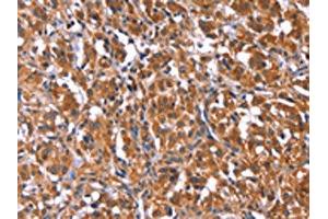 The image on the left is immunohistochemistry of paraffin-embedded Human thyroid cancer tissue using ABIN7192753(TDP2 Antibody) at dilution 1/40, on the right is treated with synthetic peptide. (TDP2 抗体)