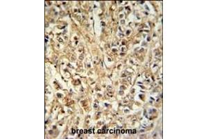 DDX6 Antibody (Center) (ABIN653855 and ABIN2843115) IHC analysis in formalin fixed and paraffin embedded breast carcinoma followed by peroxidase conjugation of the secondary antibody and DAB staining. (DDX6 抗体  (AA 348-375))