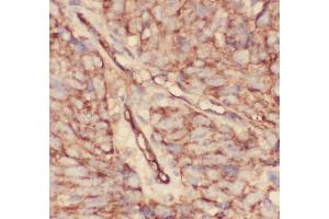 Anti-CD34 Picoband antibody,  IHC(P): Human Lung Cancer Tissue (CD34 抗体  (AA 151-385))