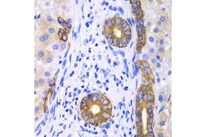 Immunohistochemistry of paraffin-embedded human liver cancer using KRT19 antibody (ABIN5970077) at dilution of 1/100 (40x lens). (Cytokeratin 19 抗体)