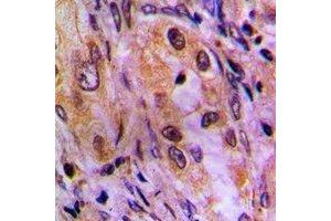 Immunohistochemical analysis of AKR1C2 staining in human lung cancer formalin fixed paraffin embedded tissue section.