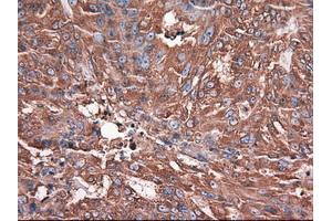 Immunohistochemical staining of paraffin-embedded Adenocarcinoma of breast using anti-CPA1 (ABIN2452647) mouse monoclonal antibody. (CPA1 抗体  (AA 1-419))