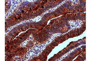 Immunohistochemistry staining of human colon adenocarcinoma (paraffin-embedded sections) with anti-Blood Group Lewis a (7LE). (Blood Group Lewis A 抗体)