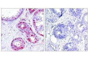 Immunohistochemical analysis of paraffin-embedded human breast carcinoma tissue using c-Jun(Phospho-Ser243) Antibody(left) or the same antibody preincubated with blocking peptide(right). (C-JUN 抗体  (pSer243))