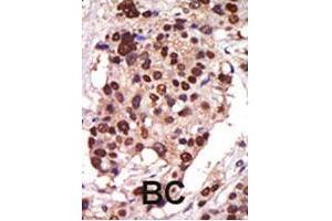 Formalin-fixed and paraffin-embedded human cancer tissue reacted with the PRKD3 polyclonal antibody  , which was peroxidase-conjugated to the secondary antibody, followed by AEC staining . (PRKD3 抗体  (Internal Region))