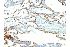Formalin-fixed, paraffin-embedded human Lung Carcinoma stained with Milk Fat Globule Monoclonal Antibody (SPM291) (MFGE8 抗体)
