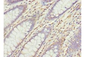 Immunohistochemistry of paraffin-embedded human colon cancer using ABIN7175357 at dilution of 1:100 (Vangl1 抗体  (AA 275-524))