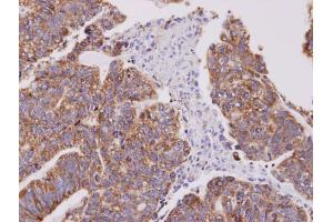 IHC-P Image Immunohistochemical analysis of paraffin-embedded human gastric cancer, using Cofilin 2, antibody at 1:100 dilution. (Cofilin 2 抗体  (C-Term))