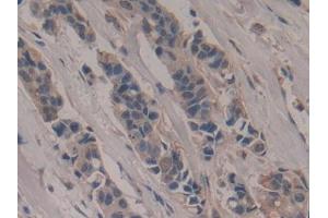 IHC-P analysis of Human Breast cancer Tissue, with DAB staining. (Poliovirus Receptor 抗体  (AA 56-309))