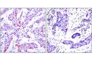 Immunohistochemistry analysis of paraffin-embedded human breast carcinoma, using ATF4 (Ab-245) Antibody. (ATF4 抗体  (AA 212-261))