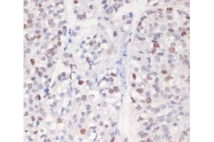 Immunohistochemistry of paraffin-embedded Human gastric cancer using Phospho-γH2A. (gamma H2AX 抗体  (pSer139))
