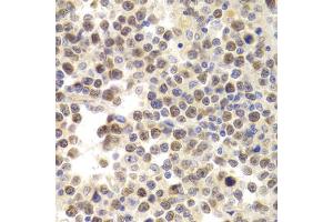 Immunohistochemistry of paraffin-embedded human B cell lymphoma using MCM4 Antibody (ABIN5971548) at dilution of 1/200 (40x lens). (MCM4 抗体)