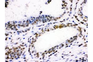 Anti- CDK1 Picoband antibody, IHC(P) IHC(P): Human Mammary Cancer Tissue (CDK1 抗体  (AA 66-297))