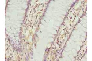 Immunohistochemistry of paraffin-embedded human colon cancer using ABIN7163544 at dilution of 1:100