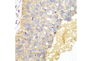 Immunohistochemistry of paraffin-embedded human lung cancer using EPCAM antibody (ABIN5970523) at dilution of 1/100 (40x lens). (EpCAM 抗体)