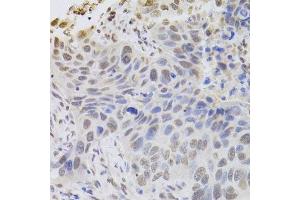 Immunohistochemistry of paraffin-embedded human esophageal cancer using HDGF Antibody. (HDGF 抗体  (AA 1-240))
