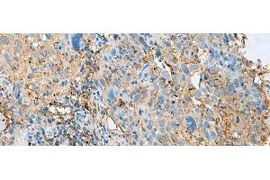 Immunohistochemistry of paraffin-embedded Human cervical cancer tissue using HLA-DPB1 Polyclonal Antibody at dilution of 1:50(x200) (HLA-DPB1 抗体)