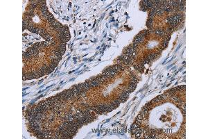 Immunohistochemistry of Human colon cancer using IDH2 Polyclonal Antibody at dilution of 1:60 (IDH2 抗体)
