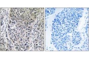 Immunohistochemistry analysis of paraffin-embedded human lung carcinoma tissue, using BRP16 Antibody. (FAM203B 抗体  (AA 251-300))