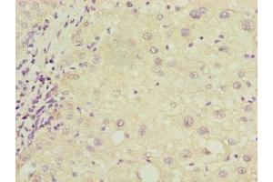 Immunohistochemistry of paraffin-embedded human liver cancer using ABIN7149150 at dilution of 1:100 (COX17 抗体  (AA 1-63))