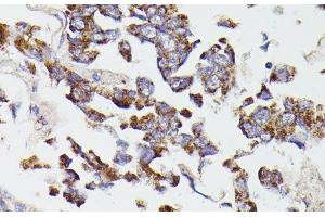 Immunohistochemistry of paraffin-embedded Human lung cancer using SUCLG2 Polyclonal Antibody at dilution of 1:100 (40x lens). (SUCLG2 抗体)